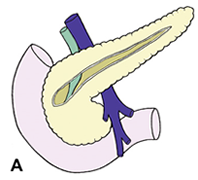 Kronik Pankreatit Cerrahisi