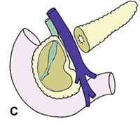 Kronik Pankreatit Cerrahisi