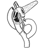 Kronik Pankreatit Cerrahisi